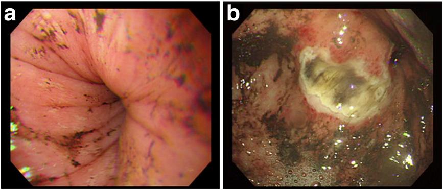 Although a hiatal hernia was not detected, an active ulcerative lesion was observed at the middle gastric body (Figure 2).