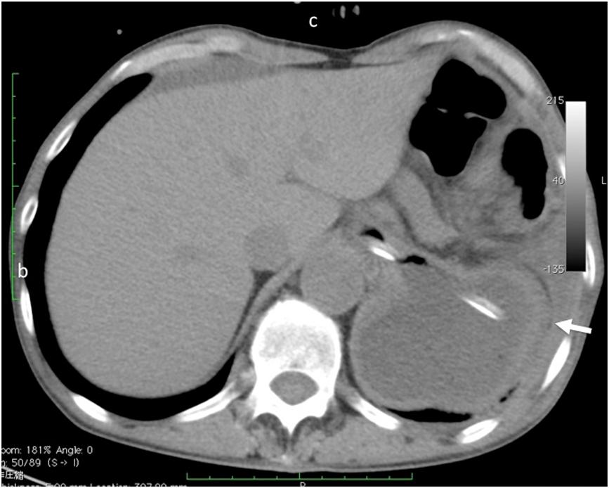 Takemura et al. Journal of Medical Case Reports 2013, 7:50 Page 3 of 5 Figure 3 Chest computed tomography showing a large fluid-filled structure in the retrocardiac space.