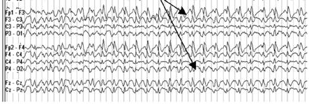 EEG in non-convulsive status epilepticus Focal NCSE Primary 1) Repetitive generalized or focal spike, sharp waves, spike and wave, or sharp and slow