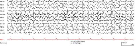 Epilepsia 2002 Focal electrographic seizure activity Generalized NCSE Absence status epilepticus Generalized electrographic seizure activity Classic