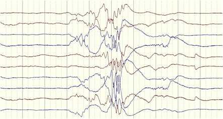 EEG-examples GA 28 weeks EEG after 71