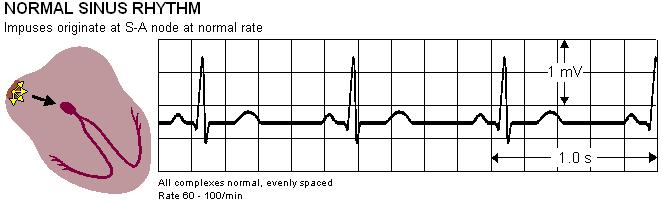 ECG basics Amplitude: 1-5 mv