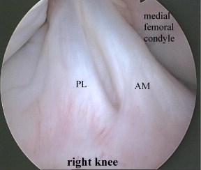 bundles: named for tibial insertion Anteromedial tight in flexion Posterolateral tight in