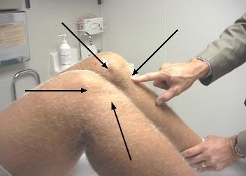 TIBIAL DROP BACK TEST Compare prominence of proximal tibia to femoral
