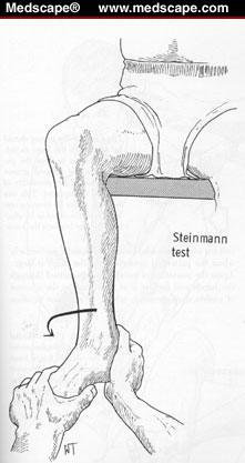 STEINMANN S TEST Patient sitting at end of exam table Knee flexed to 90º Examiner internally/externally rotates foot