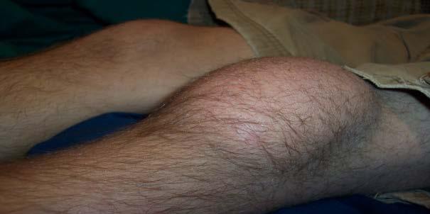 Prepatellar Bursitis Swelling anterior to patella Common in people on knees for