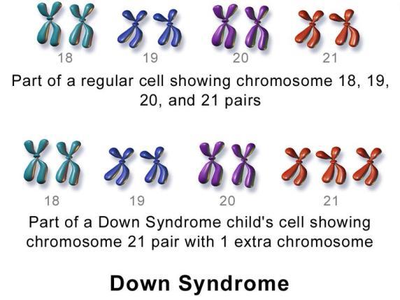 Down syndrome: Caused due to presence of an additional copy of the chromosome number 21 (trisomy of 21). This disorder was first described by Langdon Down (1866).
