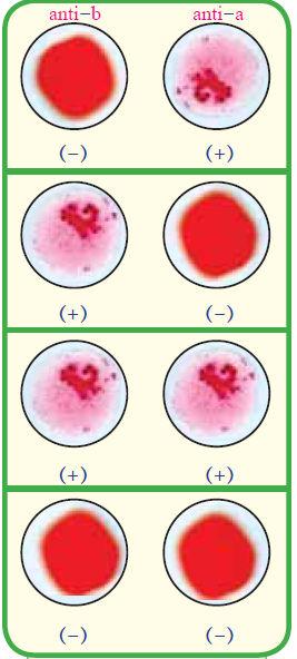 Fig. (3) Blood coagulation and blood group Possible risks of blood transfusion There are some risks which the recipient (who takes blood) may be exposed to:- 1- When a person receives blood which is