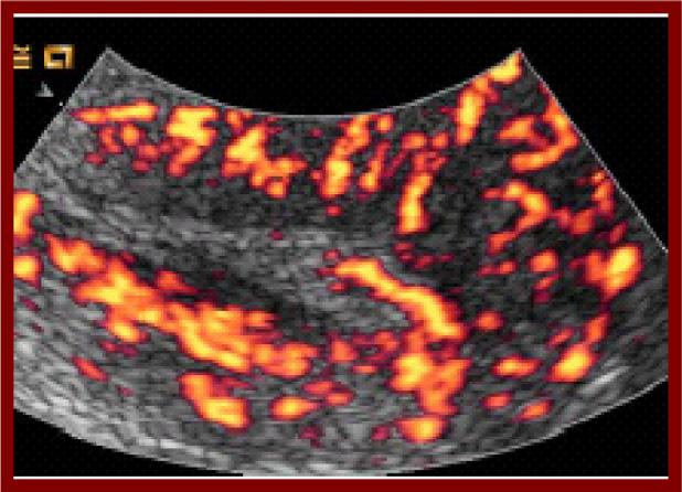 24 M. El-Morsi Aboul-Fotouh et al. According to power Doppler flow mapping, three different vascular patterns were defined (2): 1.