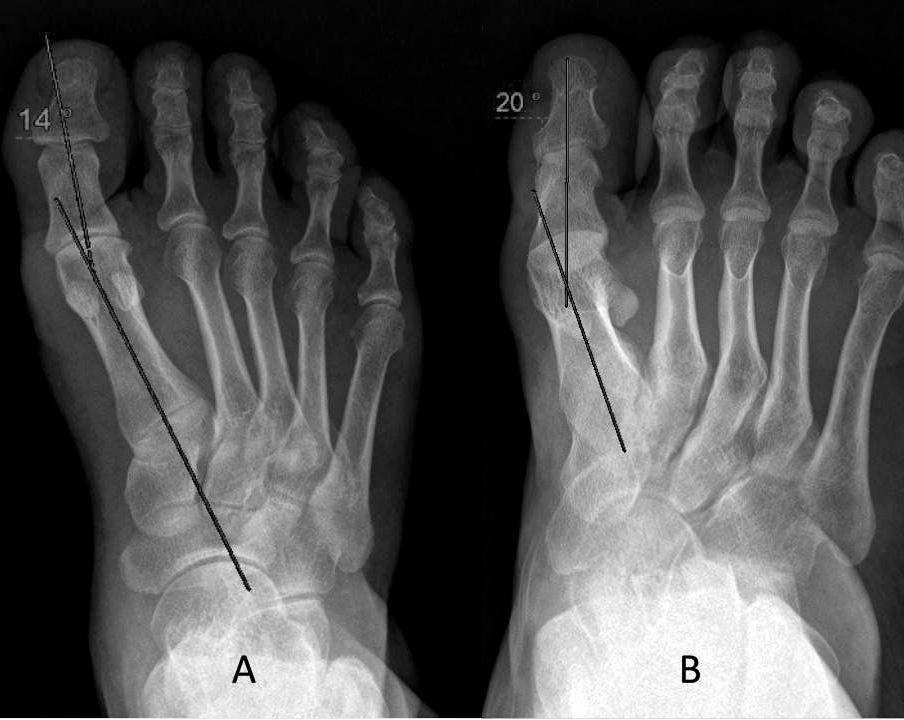 The severity of deformity is typically classified as mild, moderate, or severe on the basis of certain angles of the bones of the foot as measured on transverse dorsoplantar radiographs (1 7, 9, 11