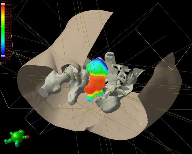 Intensity Modulated Radiation Therapy (IMRT) A highly sophisticated form of 3-D CRT allowing radiation to be shaped more exactly to fit the tumor Radiation is broken into