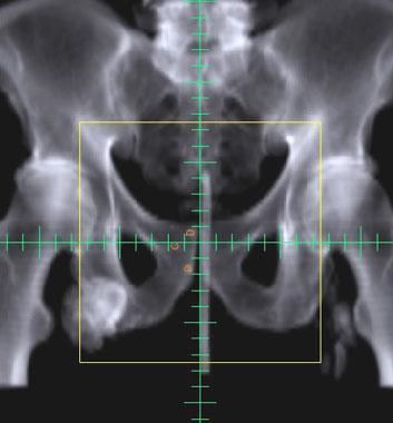 Image Guidance (Fiducial Markers ) For patients treated with 3-D or IMRT Physicians use frequent imaging of the tumor, bony anatomy or implanted fiducial markers for daily set-up accuracy; Imaging