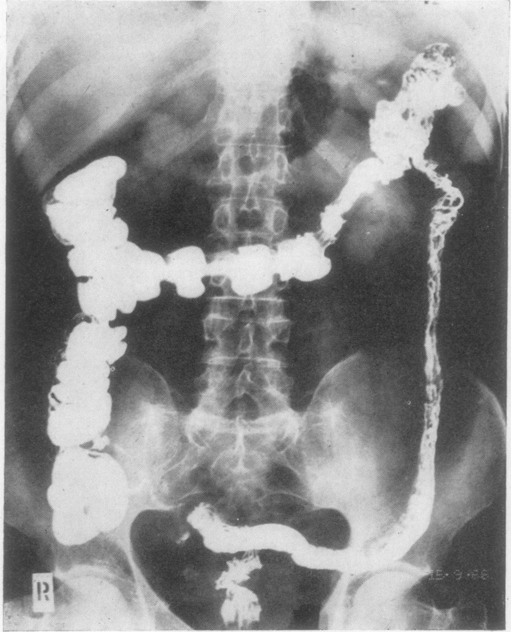 22 ANNALS OF THE RHEUMATIC DISEASES tion and all of them showed the changes of mild ulcerative colitis on x-ray as described by Fennessy, Sparberg, and Kirsner (1966): poor contractions of the bowel,