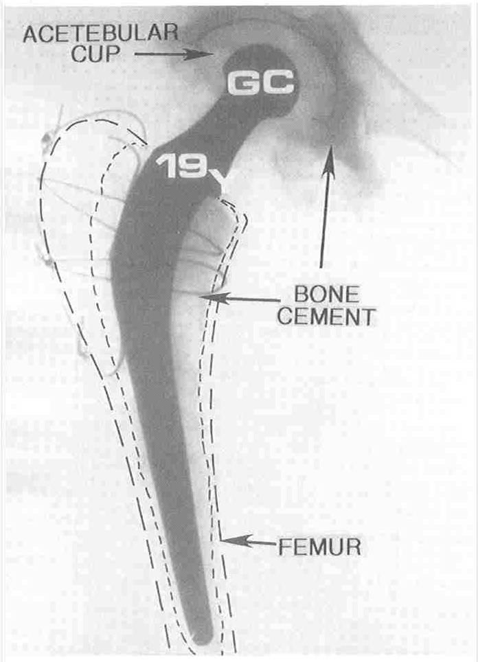 Example PMMA Bonded Hip Replacement
