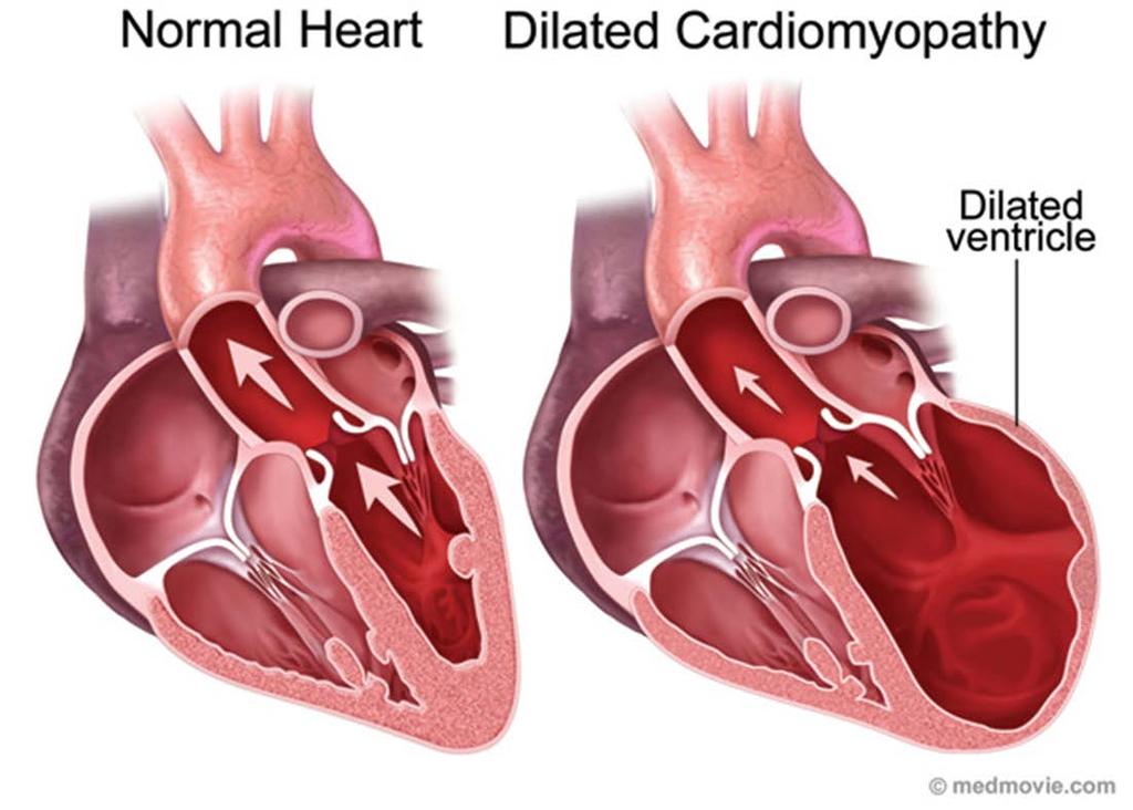 Complications of Afib Heart Failure Afib can cause heart