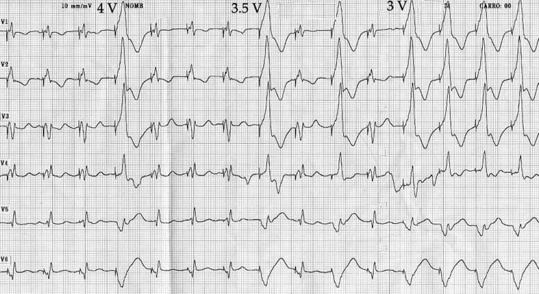 TAMBORERO, ET AL. Figure 1. Precordial leads of an ECG recorded during the capture threshold test of LV lead in pseudobipolar (LV tip to RV ring) configuration.