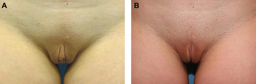 Hamori 1035 Figure 8. (A) This 29-year-old woman complained of an enlarged clitoral hood. (B) Two months after wedge labiaplasty with lateral reduction of clitoral hood. Figure 9.