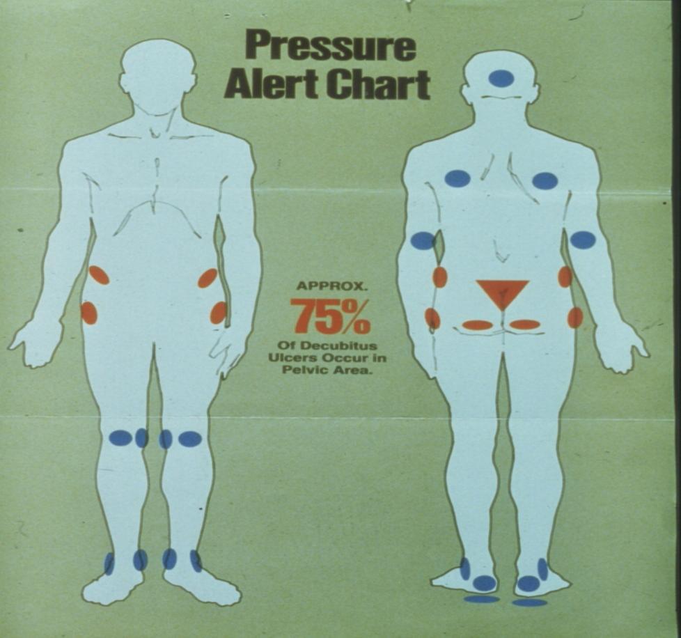 Sites of Pressure Ulcers
