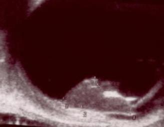 Anterior segment view of medulloepithelioma