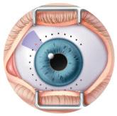 The MP3 laser probe is then gently guided along two semicircular patterns around the front of the eye just beyond where the cornea meets the sclera (white part of the eye).