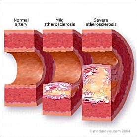 Narrowing of arteries or lack of elasticity caused by atherosclerosis (arteries clogged with