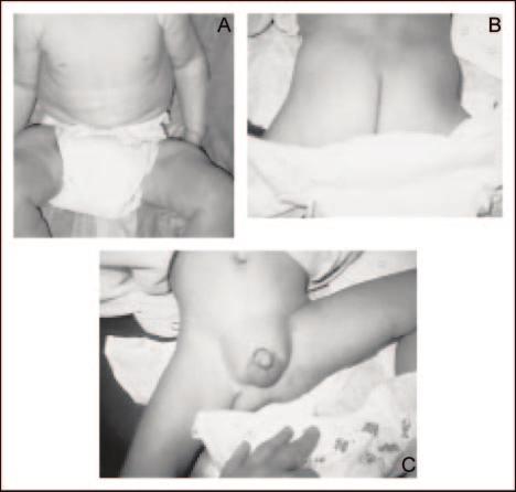Figure 3. Congenital disorders of glycosylation and unusual fat distribution. A. Inverted nipples and unusual abdominal and thigh fat distribution. B and C. Unusual suprailiac and suprapubic fat pads.