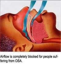 Sleep Apnea: Treatment Treatment Goal Keep the airway open so that breathing does not stop Symptoms may be relieved by: Avoidance of alcohol
