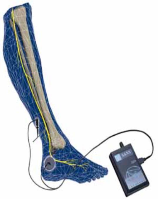 Posterior Tibial Nerve Stimulation Neuromodulation in the form of Sacral nerve stimulation or Percutaneous nerve stimulation or Transcutaneous nerve