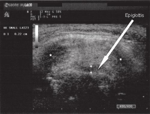 Chau et al./sonographic measurement of the epiglottis 431 (a) (b) Figure 1. (a) Ultrasound scan showing the "face appearance" standard view.