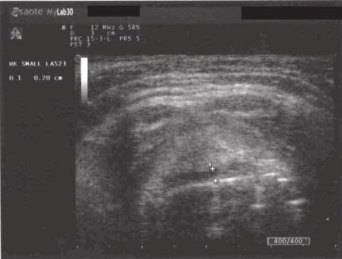 The thickness of the epiglottis is measured by the two crosses over the "mouth". This scan is showing a "smiley face". (b) This epiglottic ultrasound is showing a "sad face".