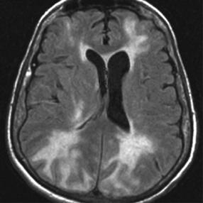 Hypertensive Encephalopathy Rapid increase in BP (DBP >140) Uncontrolled Cerebral Blood Flow Cerebral vasospam, punctate hemorrhage, ischemia, increased vascular permeability Cerebral Edema