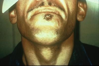 Primary syphilis 3 weeks after infection Classic sign = chancre Resolves spontaneously within 3-6 weeks 1. Tramont EC. Treponema pallidum (syphilis).
