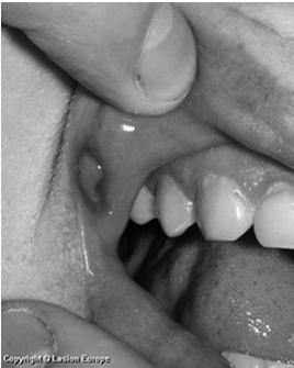 Oral