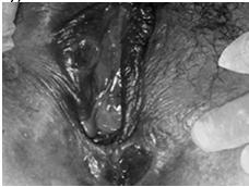 wks after exposure (range 3 90 days) local lesion at site of inoculation typically painless,