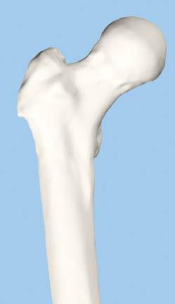 proximal to the tip of the greater trochanter.