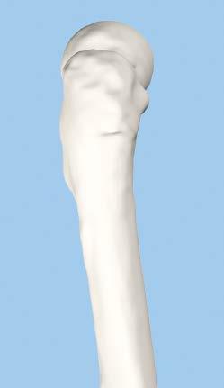 The insertion point is 10 lateral to the greater trochanter, as measured from a point 40 mm distal to the lesser trochanter.