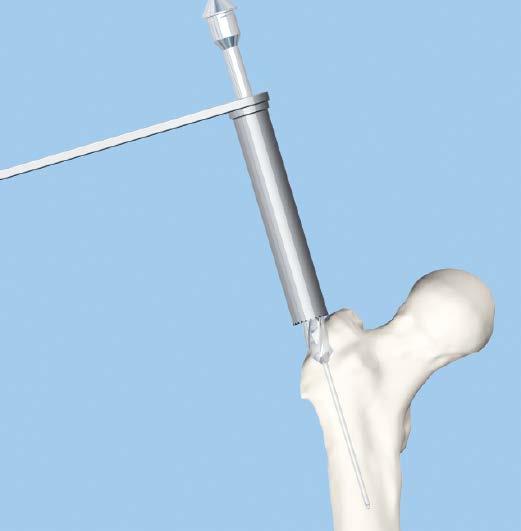 Opening the Femur 4 Open medullary canal with drill bit and flexible reamers Instruments 03.010.028 15.0 mm Cannulated Drill Bit 03.010.029 17.0 mm Cannulated Drill Bit 357.410 22.0 mm/17.