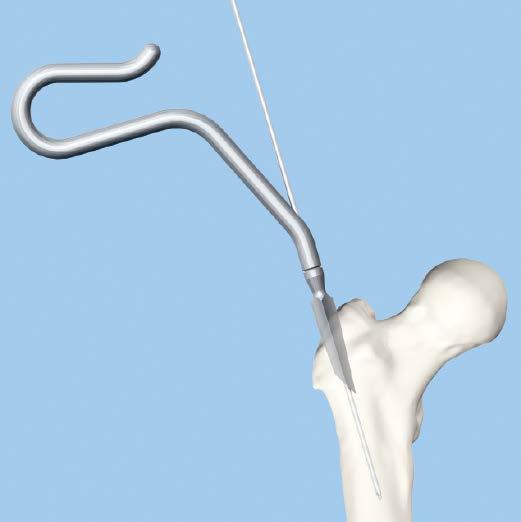 Opening the Femur 4 Alternative technique: Open medullary canal with awl continued Alternative instruments 03.010.041 14.0 mm Cannulated Awl 357.399 3.
