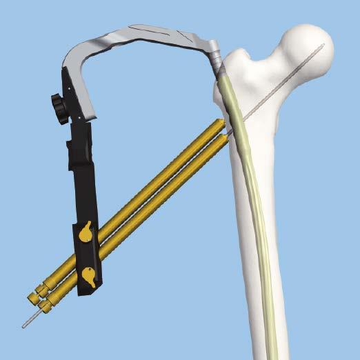 Proximal Locking Recon Remove the inferior trocar. Insert a guide wire into the femoral head approximately 5 mm from subchondral bone.