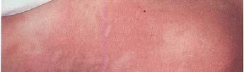 Urticaria Moderate Allergic Reaction Mild signs/symptoms with any of following: Dyspnea, possibly with wheezes Angioneurotic edema Systemic, not localized No