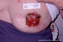 What is a fungating wound? A fungating (malignant) wound can develop when cancer that is growing under the skin breaks through creating a wound.