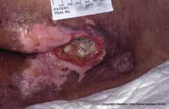 There may also be infection and areas of the wound may become ulcerated. If a fungating wound does develop, it is most likely to happen with breast cancer, head and neck cancer and melanoma.