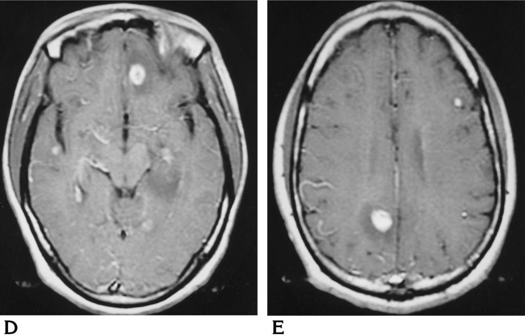 B, Axial T1-weighted (650/11/1) image shows mixed ring and nodular enhancement in pons and temporal lobe lesions.