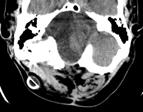 Case Conference: Neuroradiology Case 1: 22yo F w/ HA and