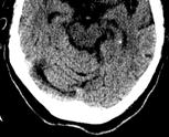 with contrast The hypodensity indicates edema / infarct.