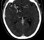 Case 7: 74yo M, may have presented with headache, seizure or