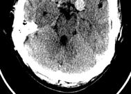 Case 10: 54yo M with unrelated neurologic