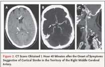 cerebral vasculature Advanced CT Imaging for Acute Stroke: CTP versus MRI CT Perfusion DWI-PWI MRI Parameters CBF, CBV, MTT, TTP CBF, CBV, MTT, TTP Definition of Penumbra Relative CBF <66%; CBV >2.