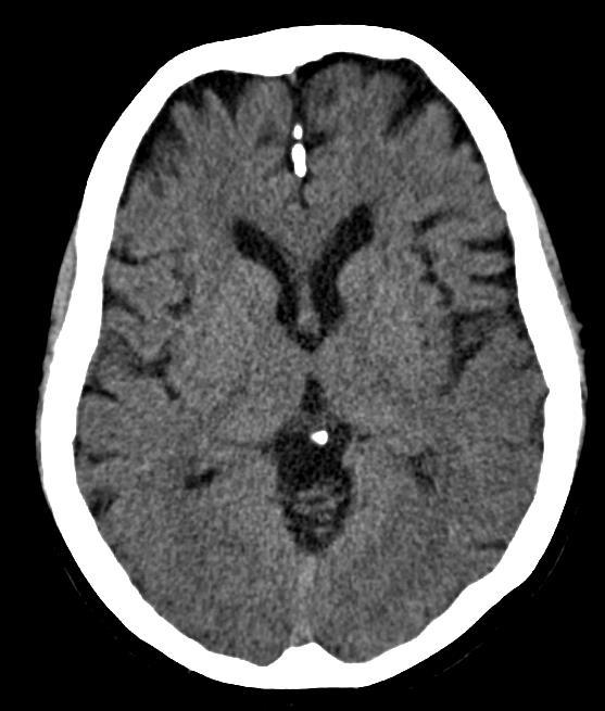 STROKE: EARLY SIGNS ON CT