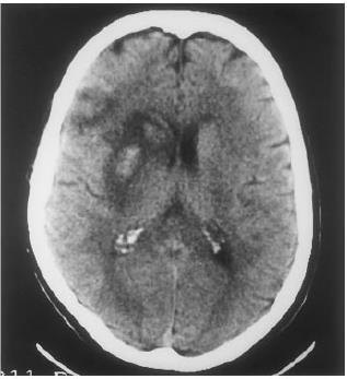 hemorrhage Commonly seen on MRI